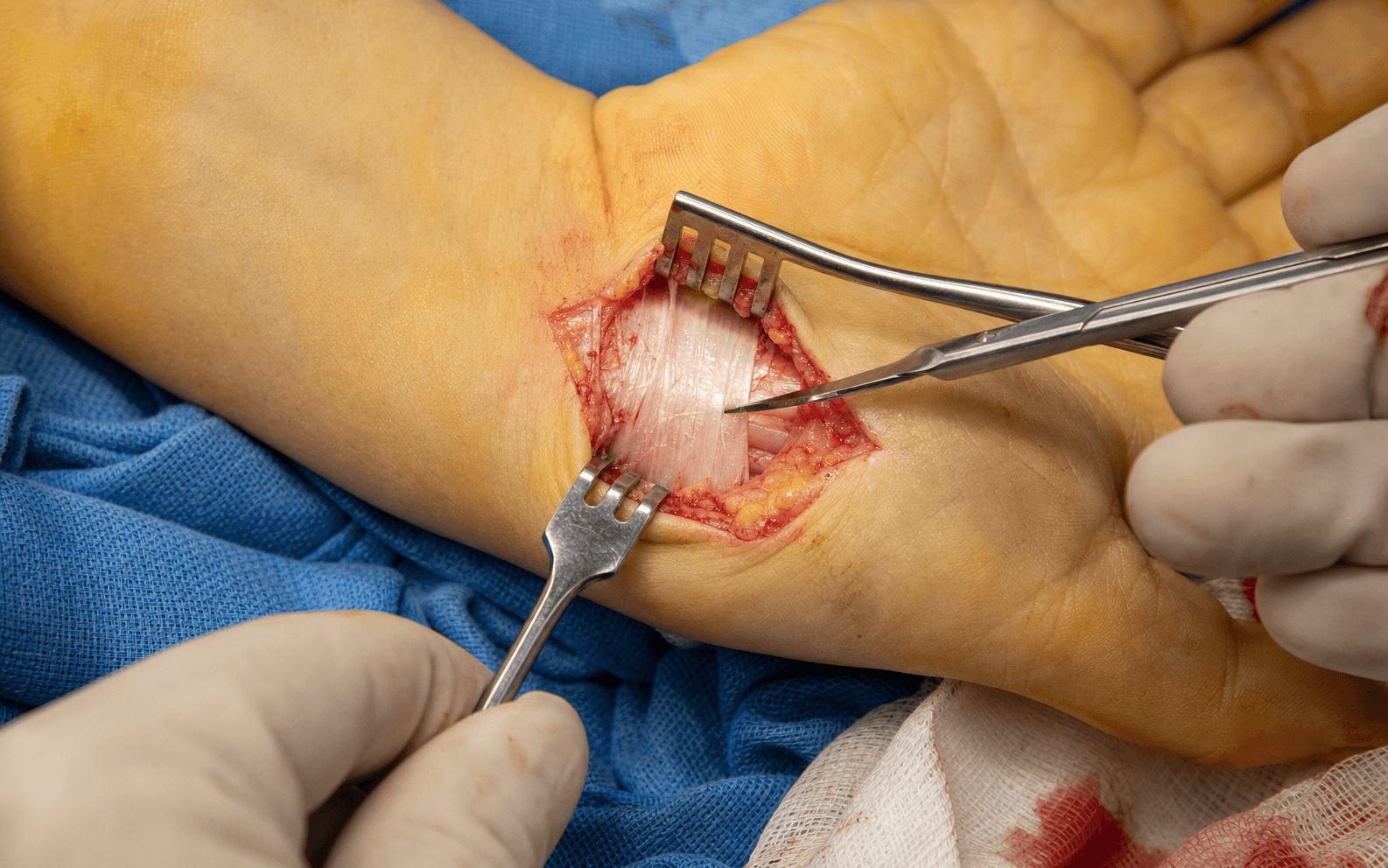 Open carpal tunnel release