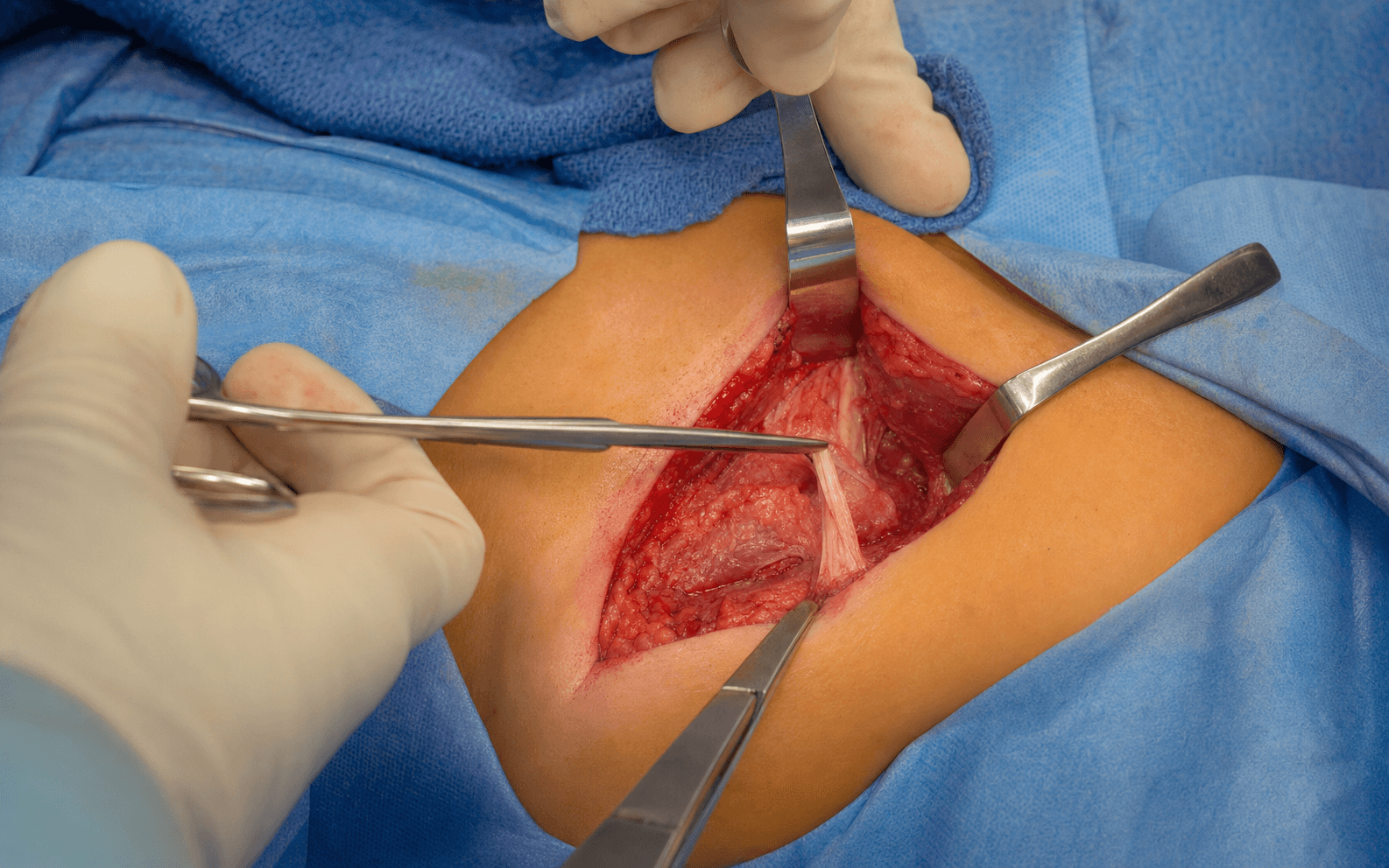 CP adductor release
