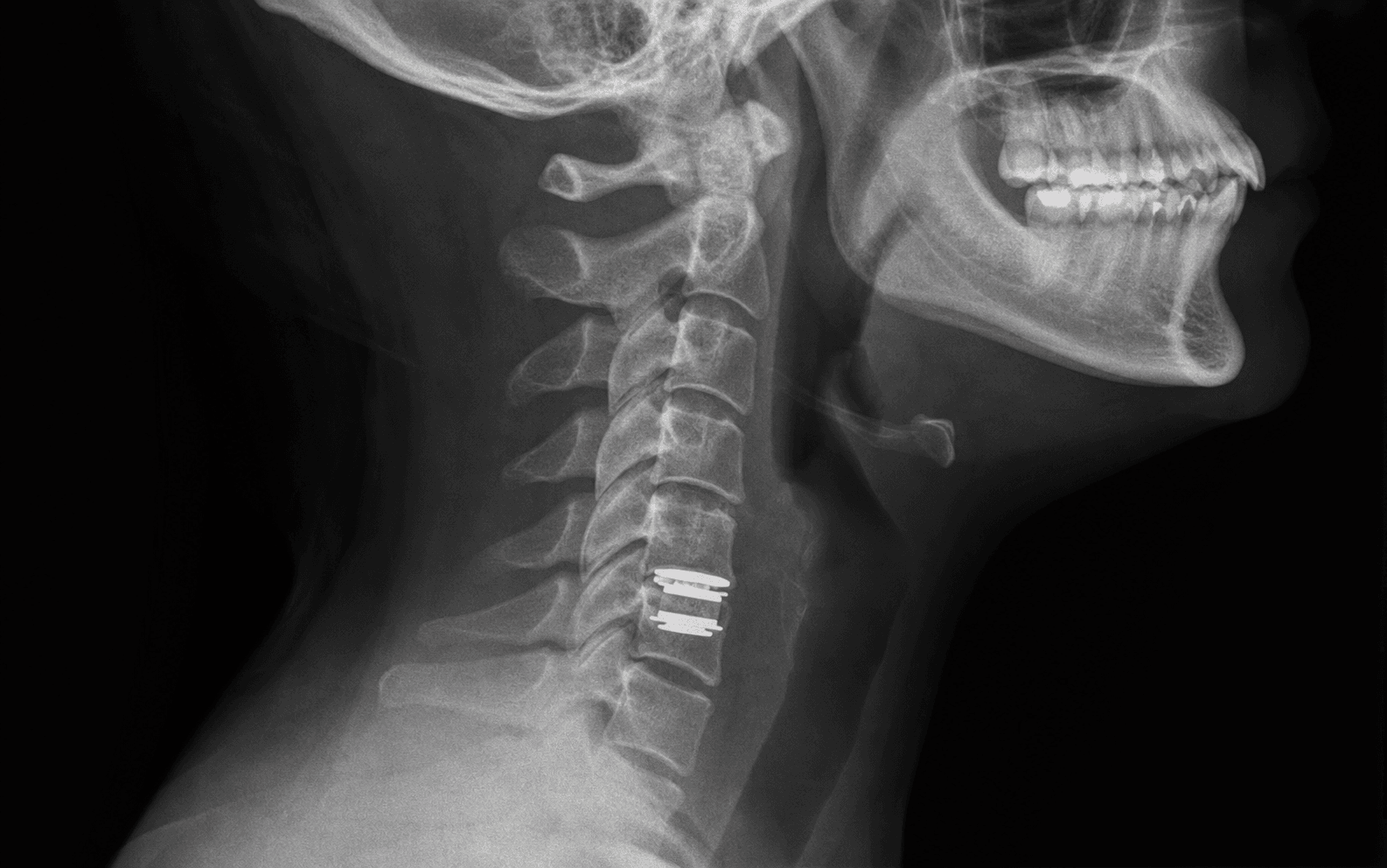 Cervical disc arthroplasty
