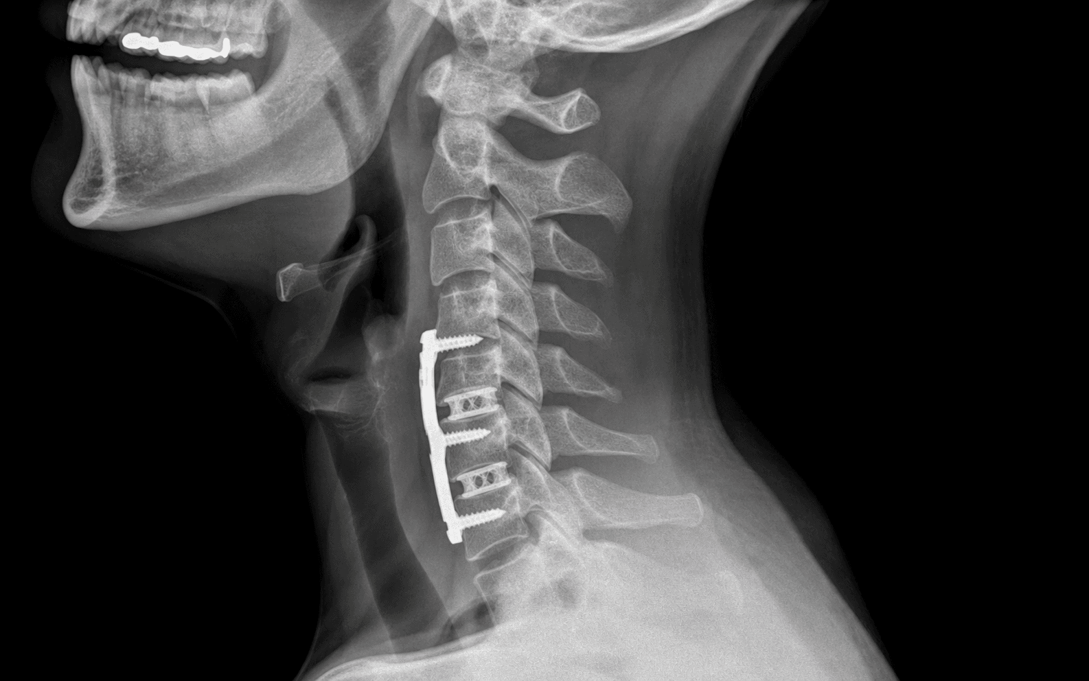 ACDF with anterior plate