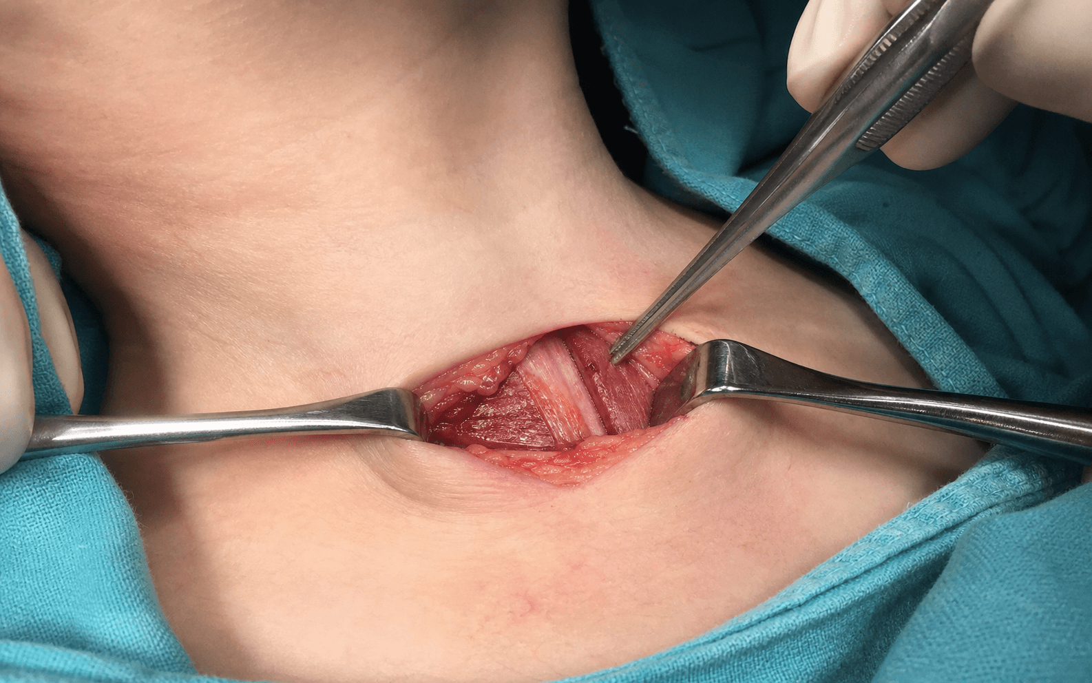 Torticollis SCM release