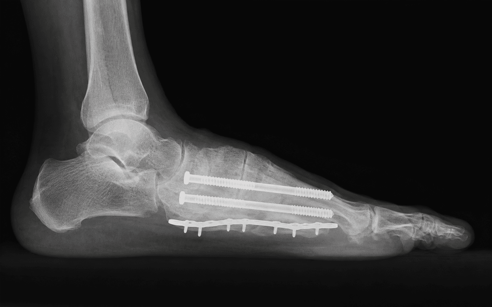 Charcot midfoot beaming reconstruction