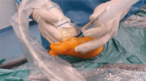 Intraoperative arthroscopic cheilectomy setup with ultrasound probe on hallux MTP joint