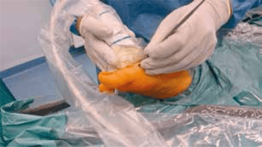 Instrument being inserted into first MTP joint during arthroscopic cheilectomy