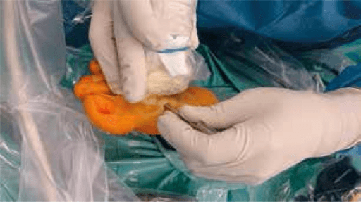 Excised bone and cartilage tissue being held after cheilectomy of first MTP joint