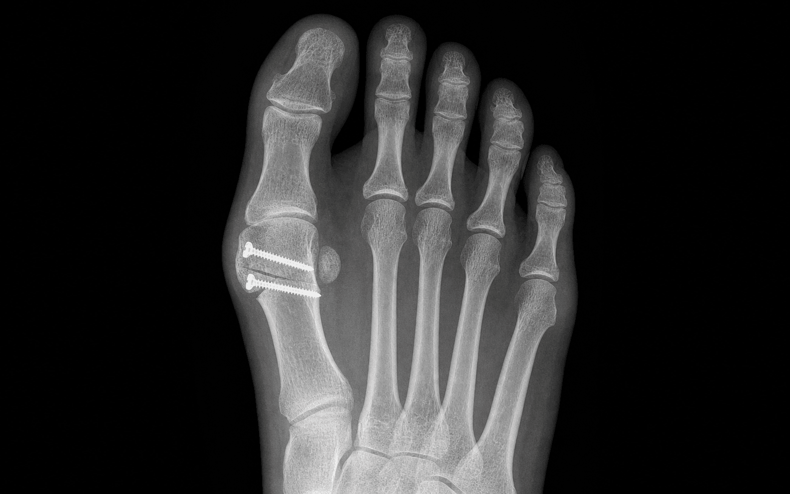 Chevron osteotomy