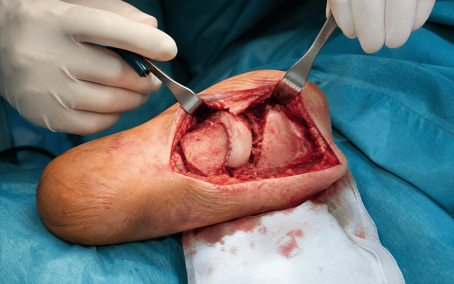 Chopart amputation