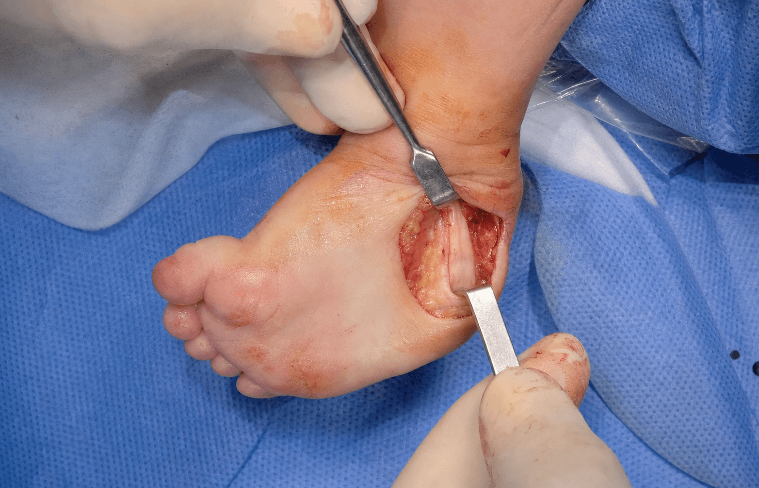 Intra-operative posteromedial release of a clubfoot