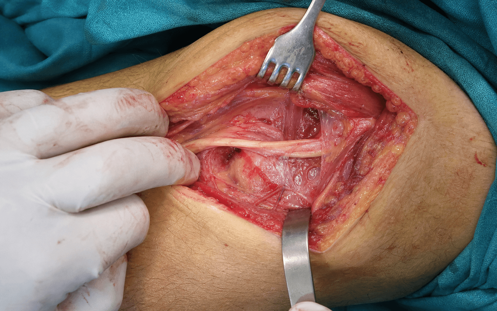 Common peroneal nerve decompression