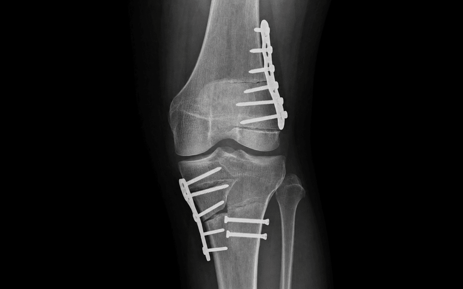 Knee realignment osteotomy