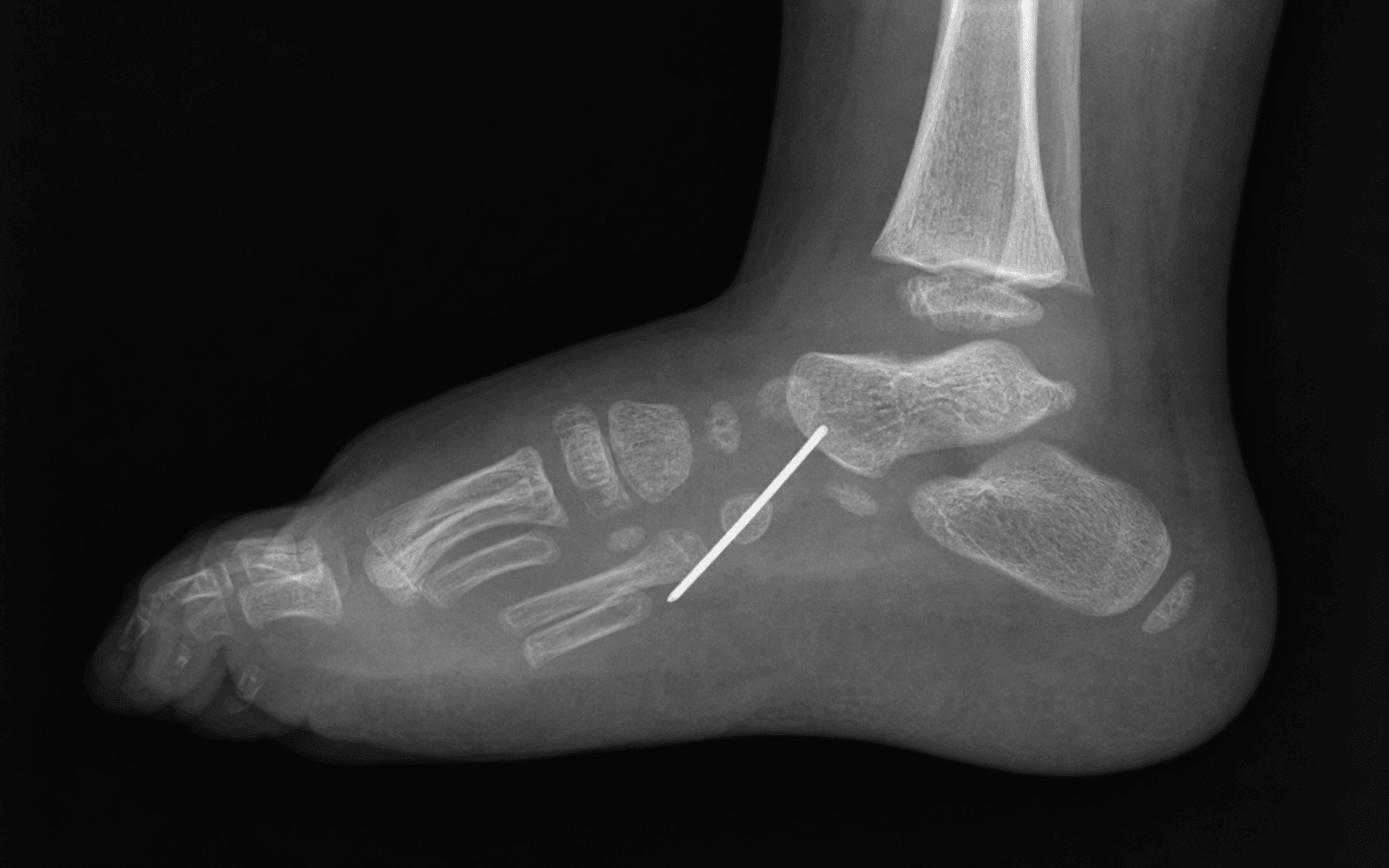 Congenital vertical talus with talonavicular pin