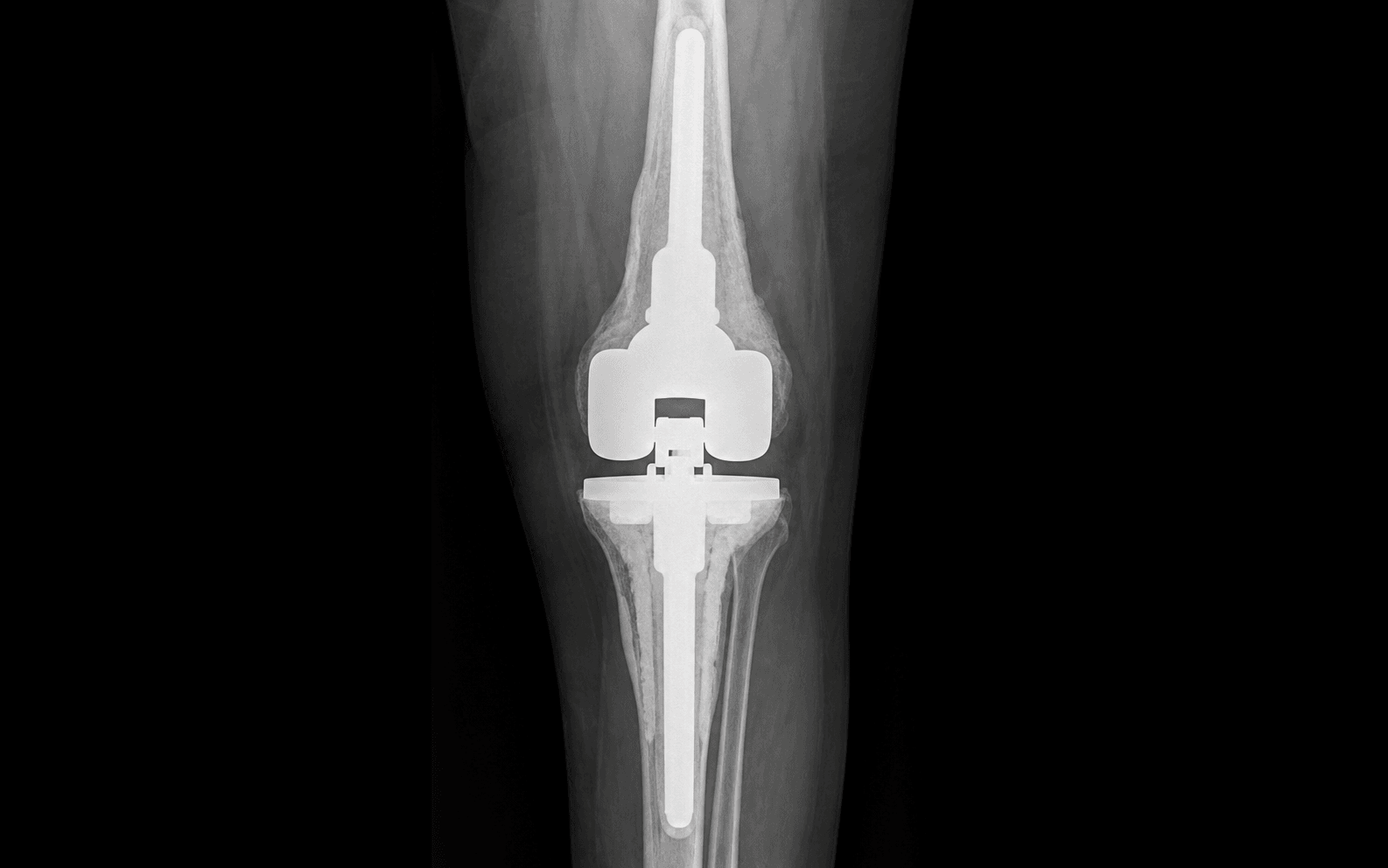 CCK revision arthroplasty