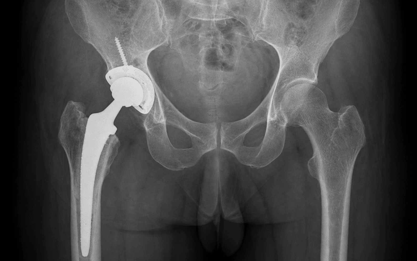 Conversion THA after hemiarthroplasty