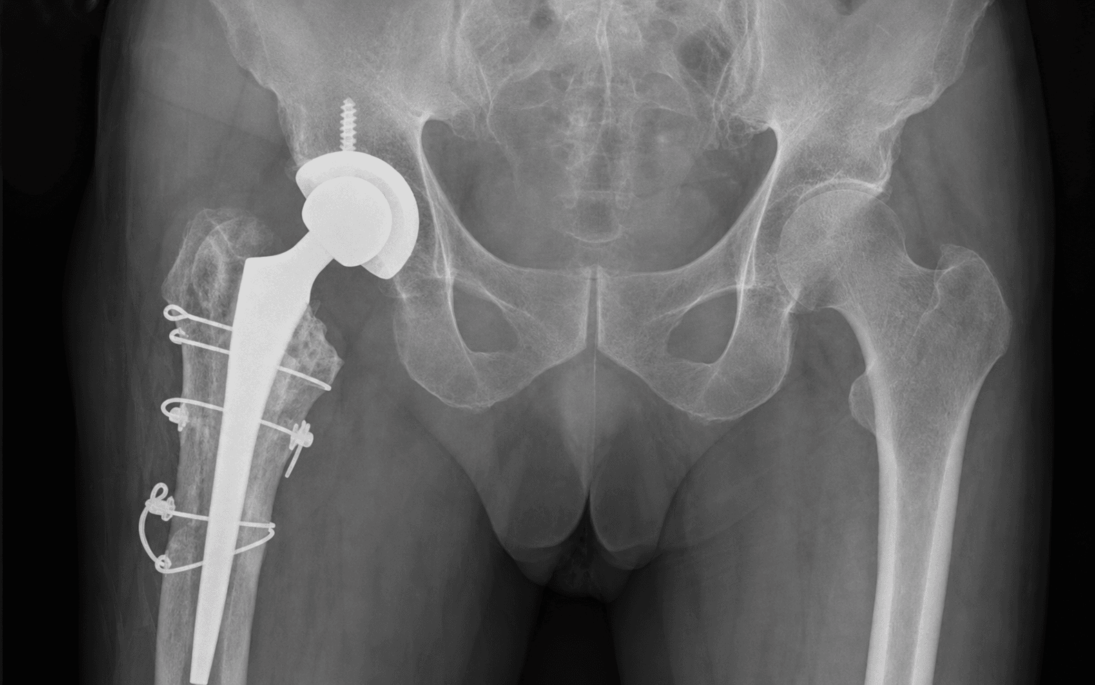 Conversion THA after failed fixation