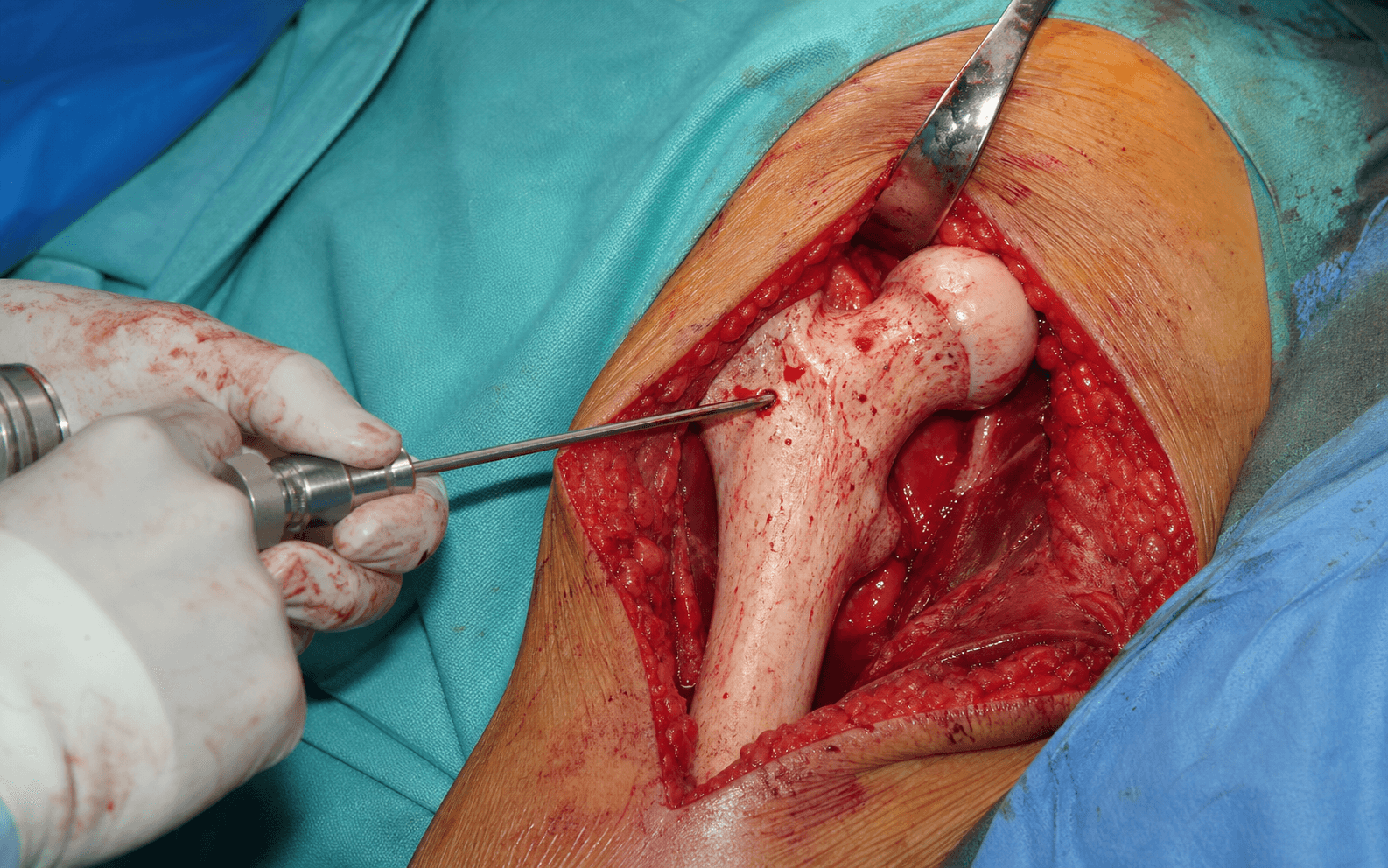 Core decompression for AVN