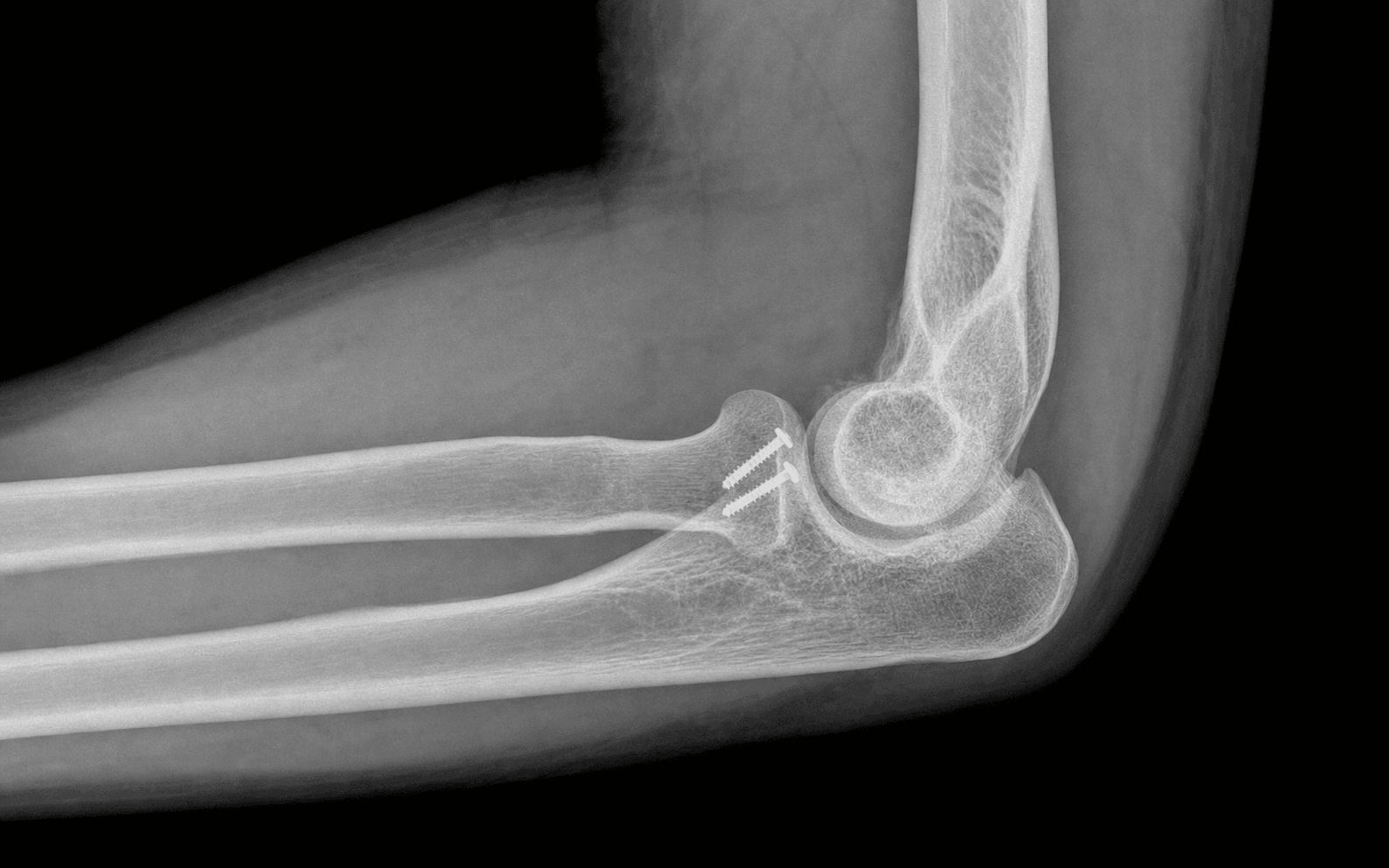 Coronoid fracture fixation