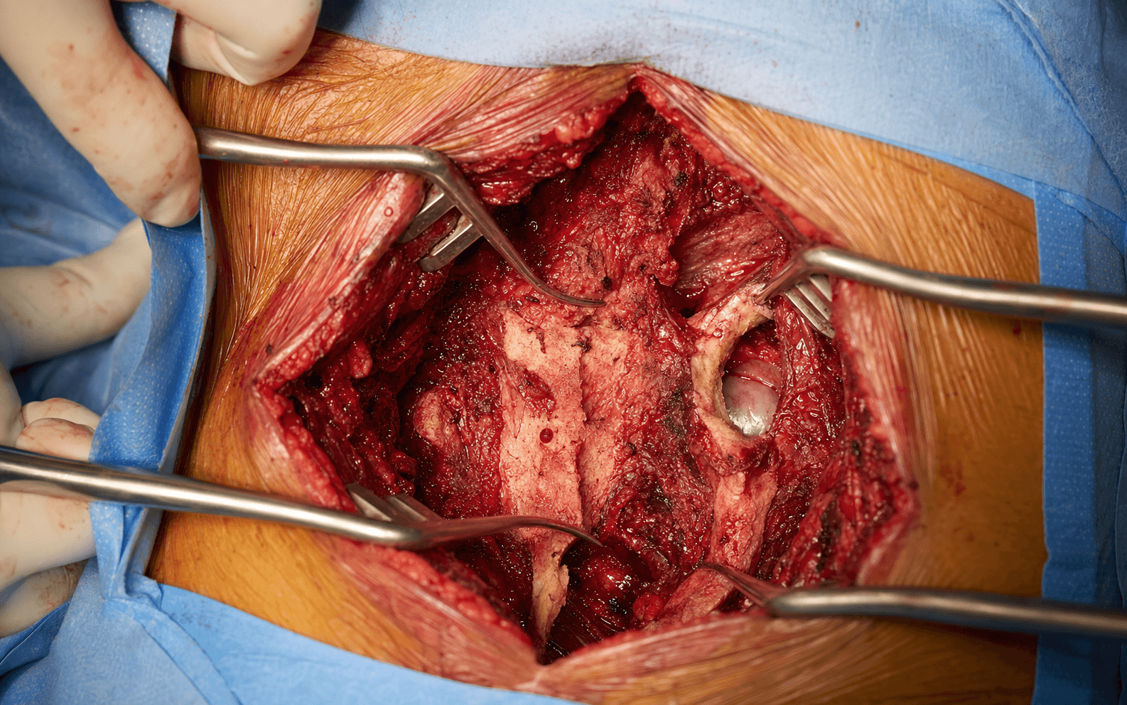 Costotransversectomy approach