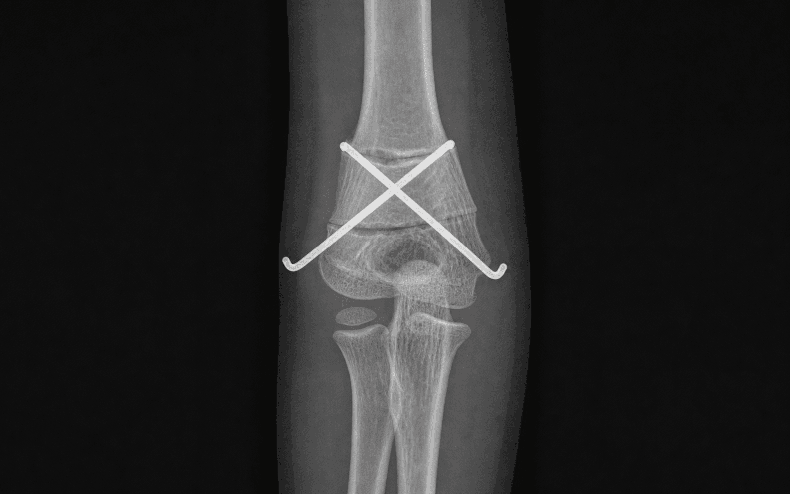 Cubitus varus osteotomy