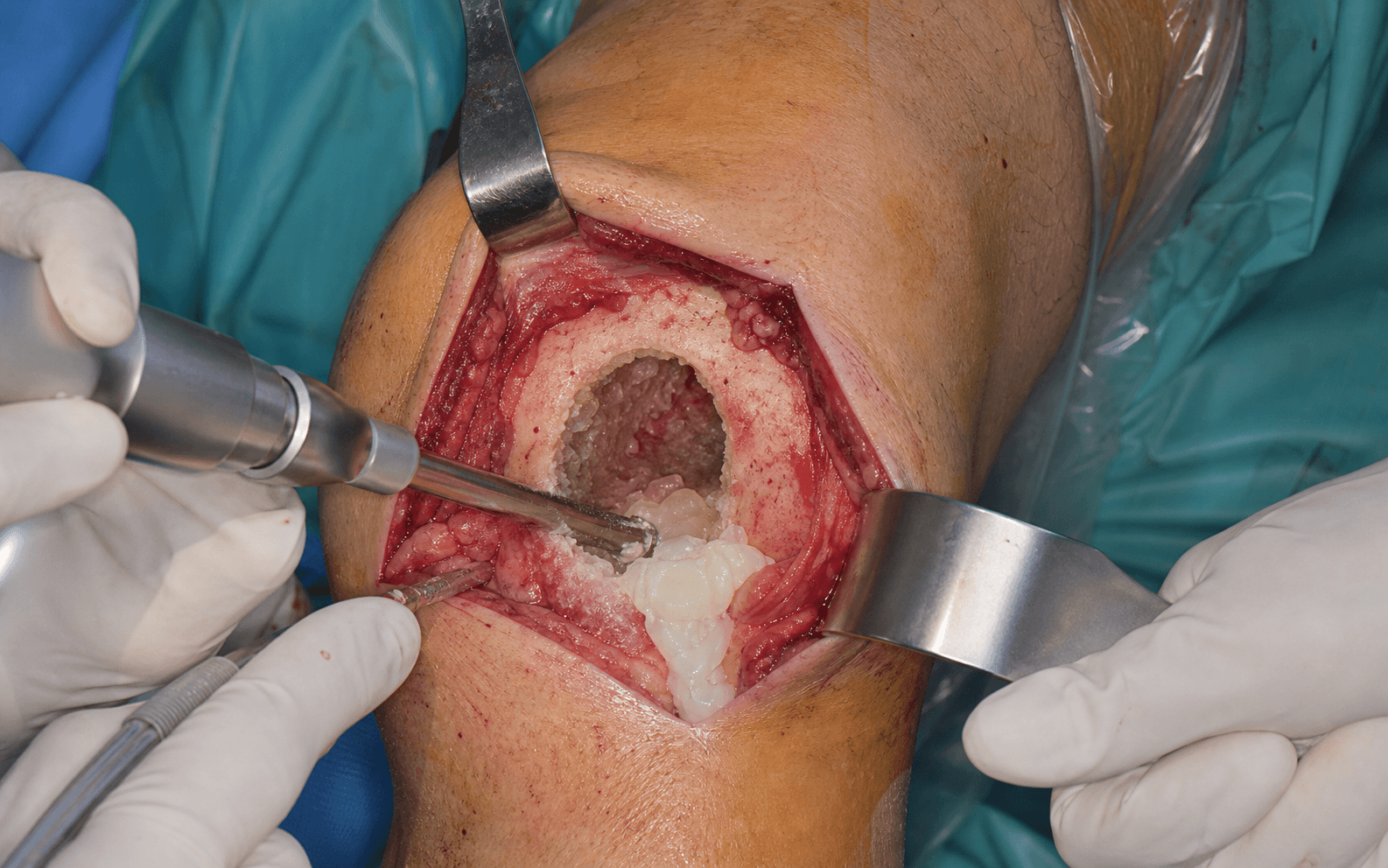 Intra-operative curettage of a bone lesion