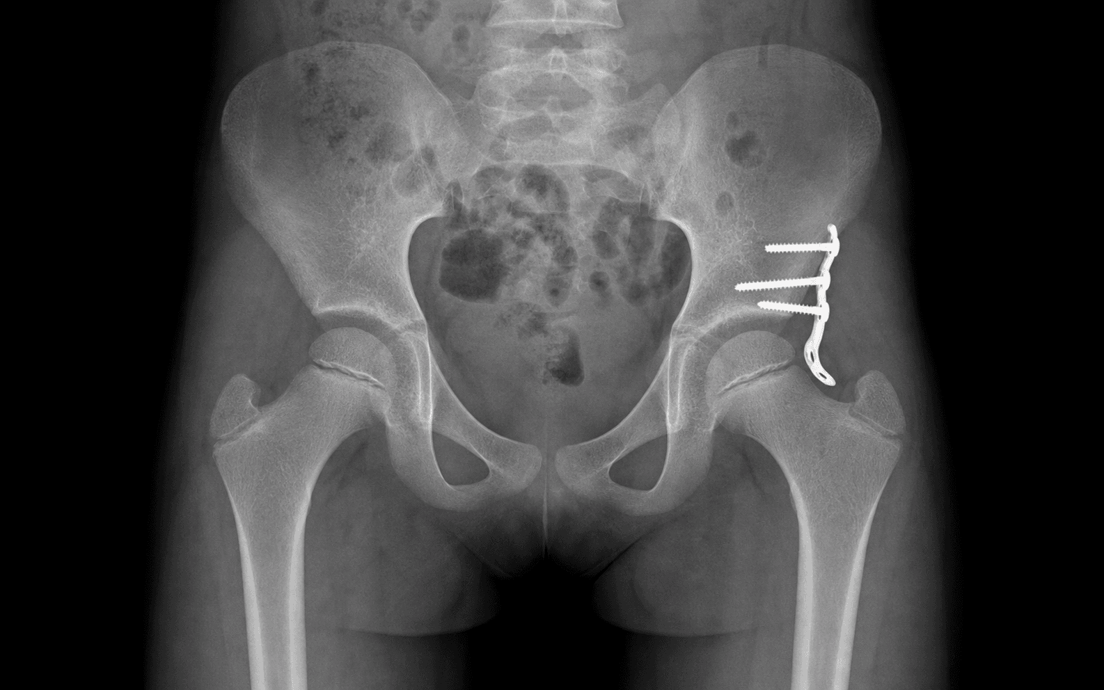 Paediatric pelvic radiograph after open reduction for hip dysplasia