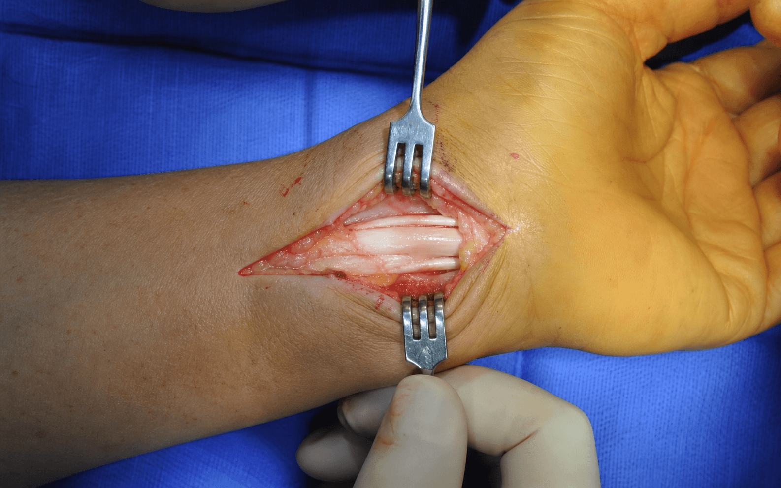 De Quervain release