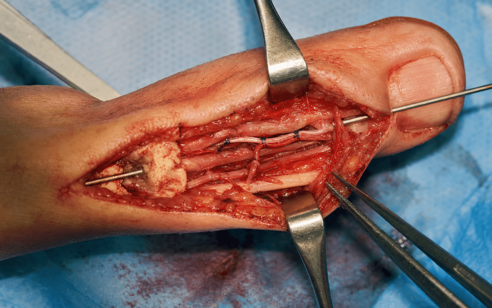 Digit replantation microsurgery