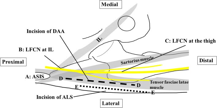 Schematic of the anterior hip showing the lateral femoral cutaneous nerve passing near the direct anterior incision between the ASIS, sartorius and tensor fasciae latae