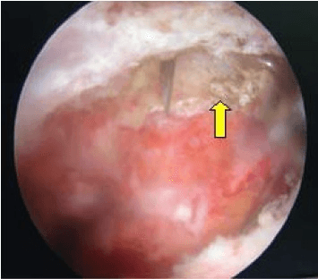 Arthroscopic view showing distal clavicle with yellow arrow pointing to degenerative osteophyte being resected