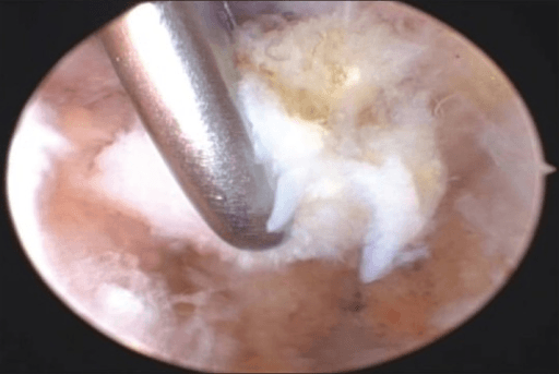 Arthroscopic view showing motorised burr performing distal clavicle resection Mumford procedure