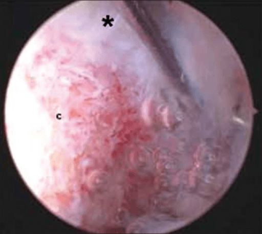 Arthroscopic view showing completed distal clavicle resection with asterisk marking clavicle end and label c for acromion