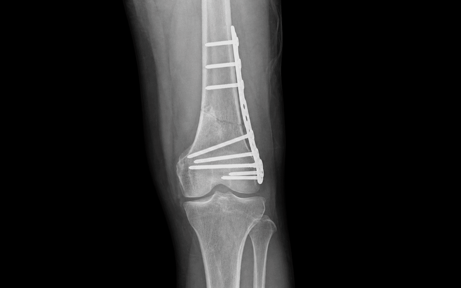 Distal femur ORIF
