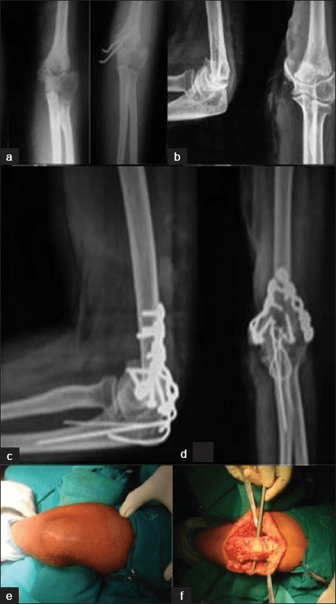 Six-panel composite showing pre-op AP and lateral X-rays, intraoperative views, and post-op radiographs of distal humerus ORIF