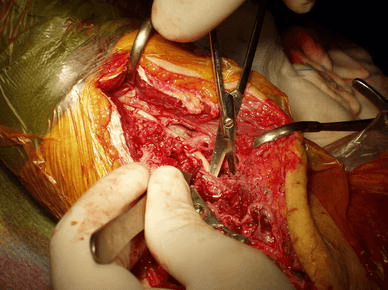 Intraoperative photograph of distal humerus dissection showing retracted tissue and exposed bone