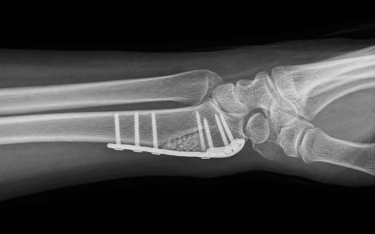 Corrective osteotomy of a distal radius malunion