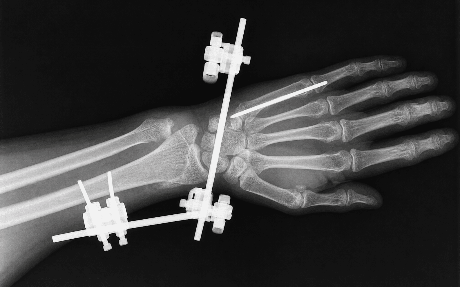 Distal radius external fixation