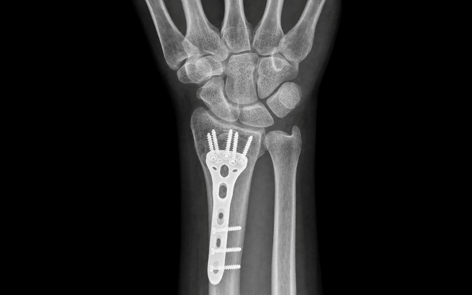 Distal radius volar locking plate