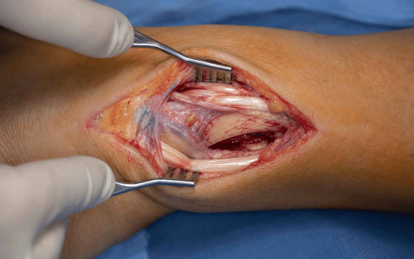 Dorsal approach to distal radius