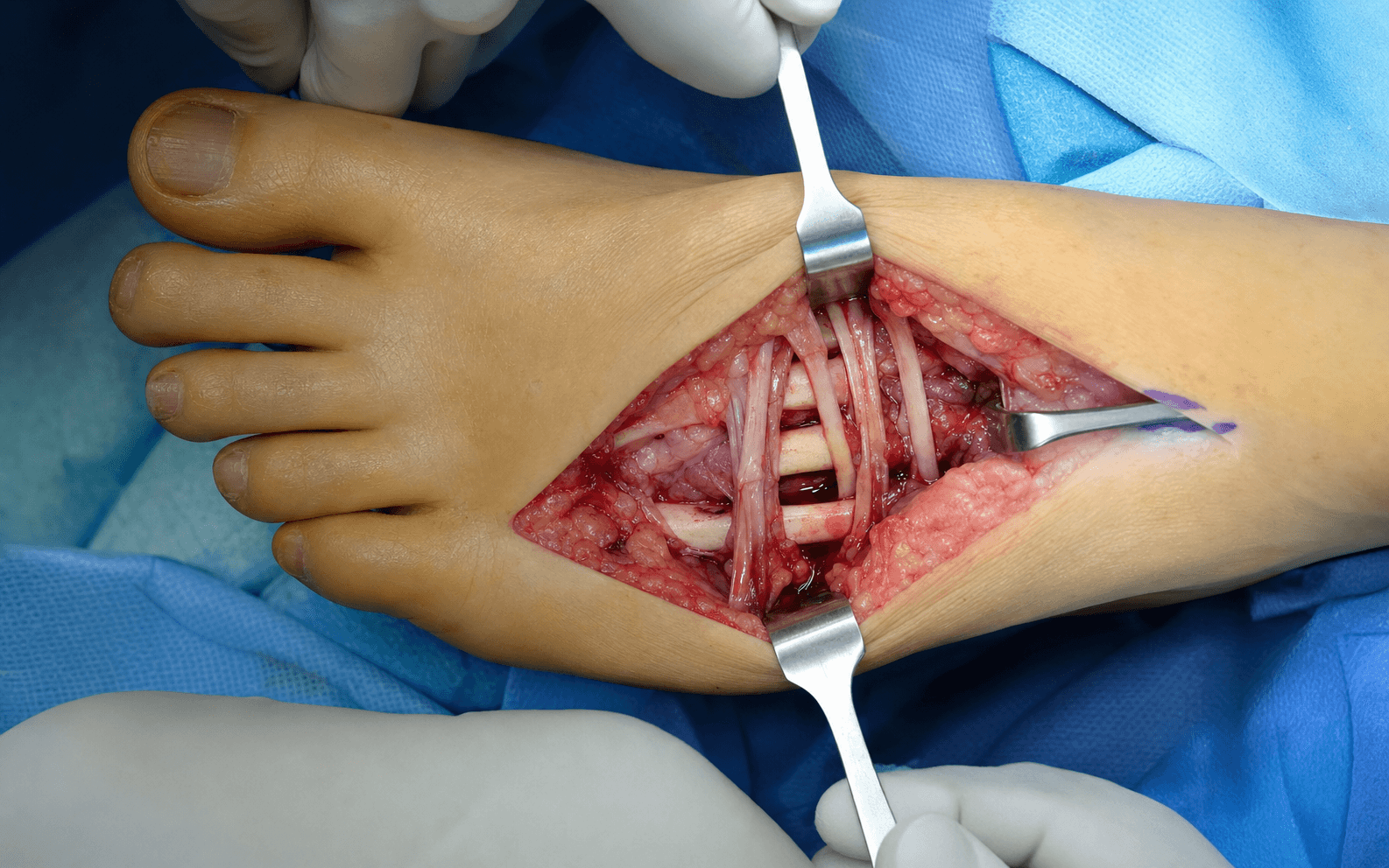 Dorsal approach to lesser metatarsals