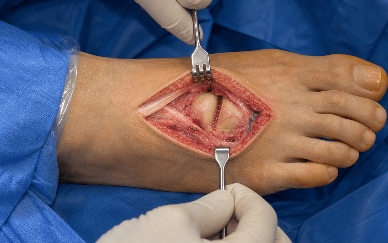 Dorsomedial approach to first MTP