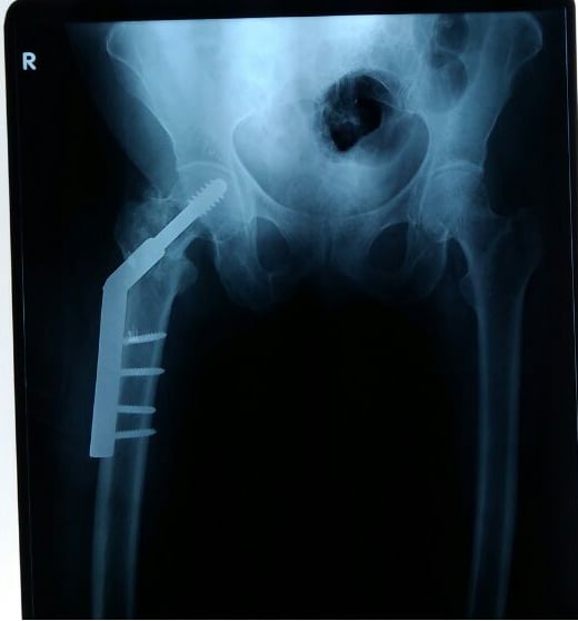 Intertrochanteric fracture fixed with a dynamic hip screw