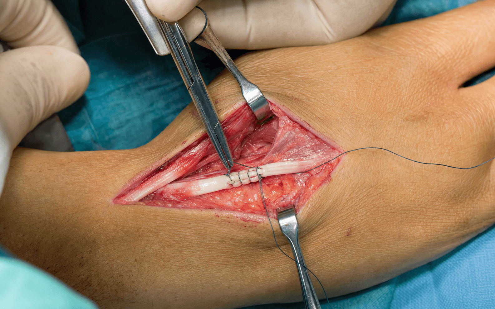 Intra-operative EIP-to-EPL tendon transfer