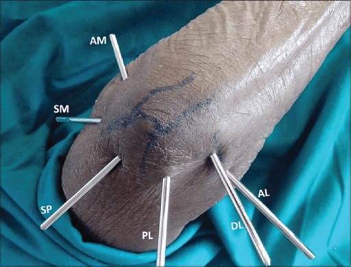 Cadaver elbow specimen with six pins marking standard arthroscopic portal positions