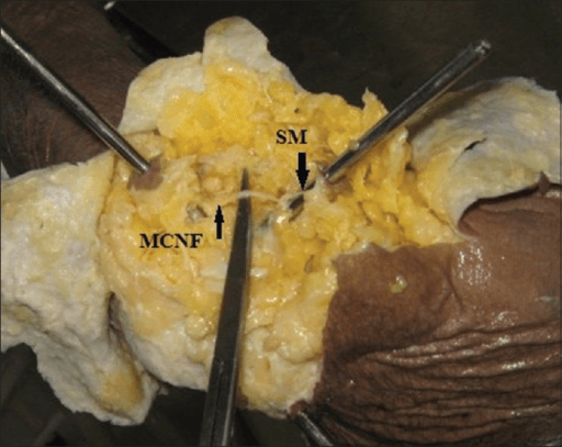 Cadaver elbow dissection showing medial cutaneous nerve of forearm in relation to arthroscopic portal