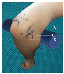 Clinical photograph of elbow with three portal sites labelled A, B, and C for arthroscopic contracture release