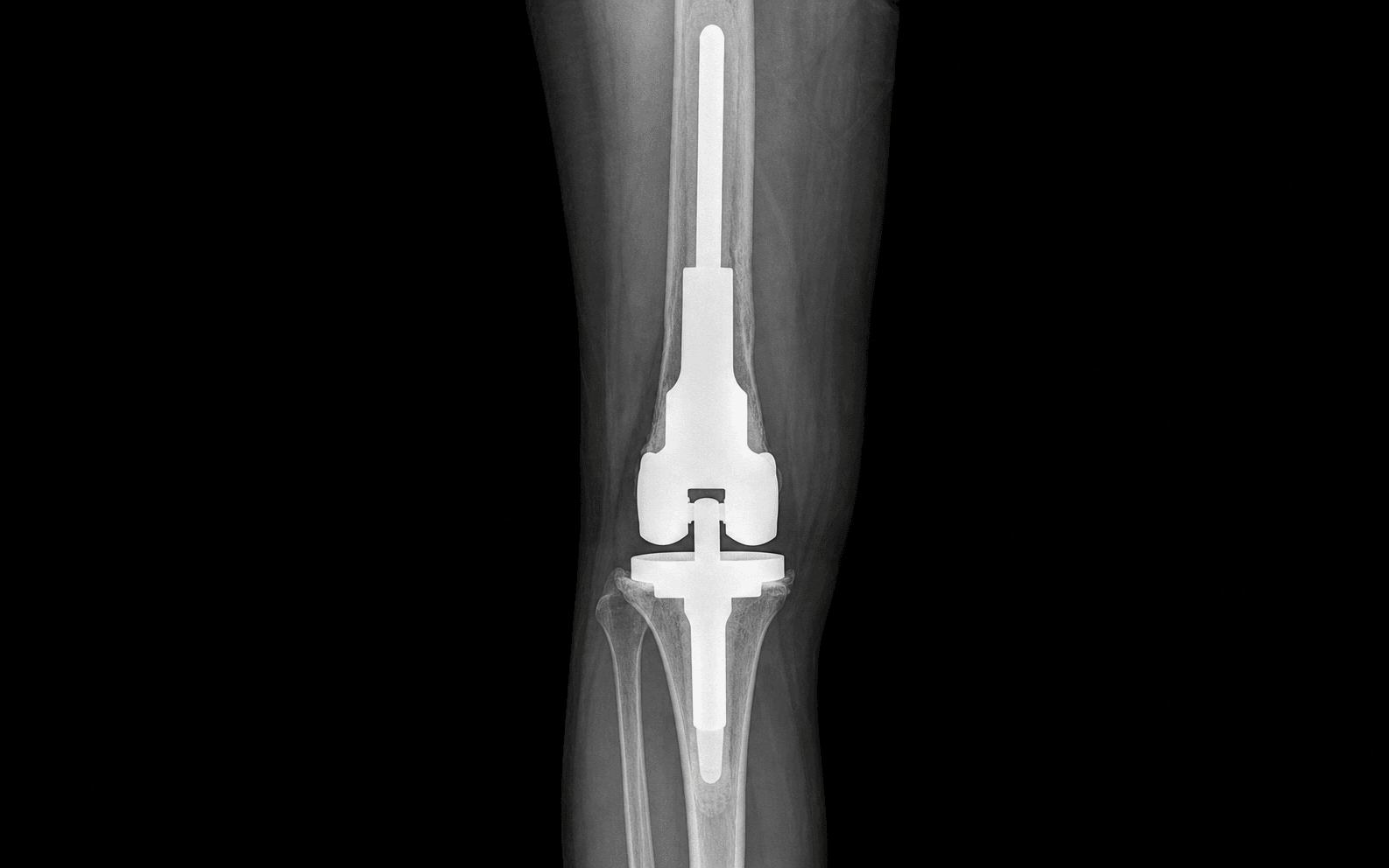 AP radiograph of a distal femoral endoprosthesis