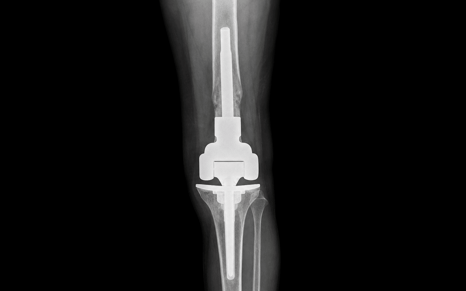Distal femur megaprosthesis