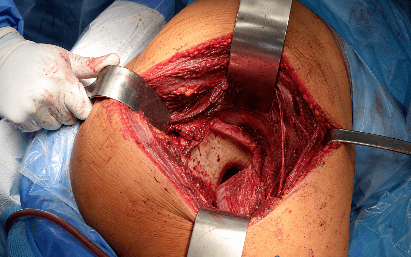 Extended iliofemoral approach