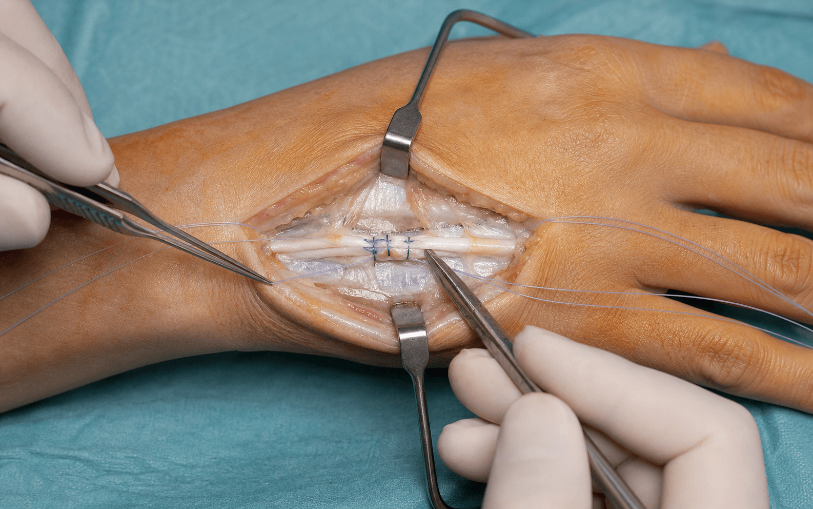 Intra-operative extensor tendon repair on the hand