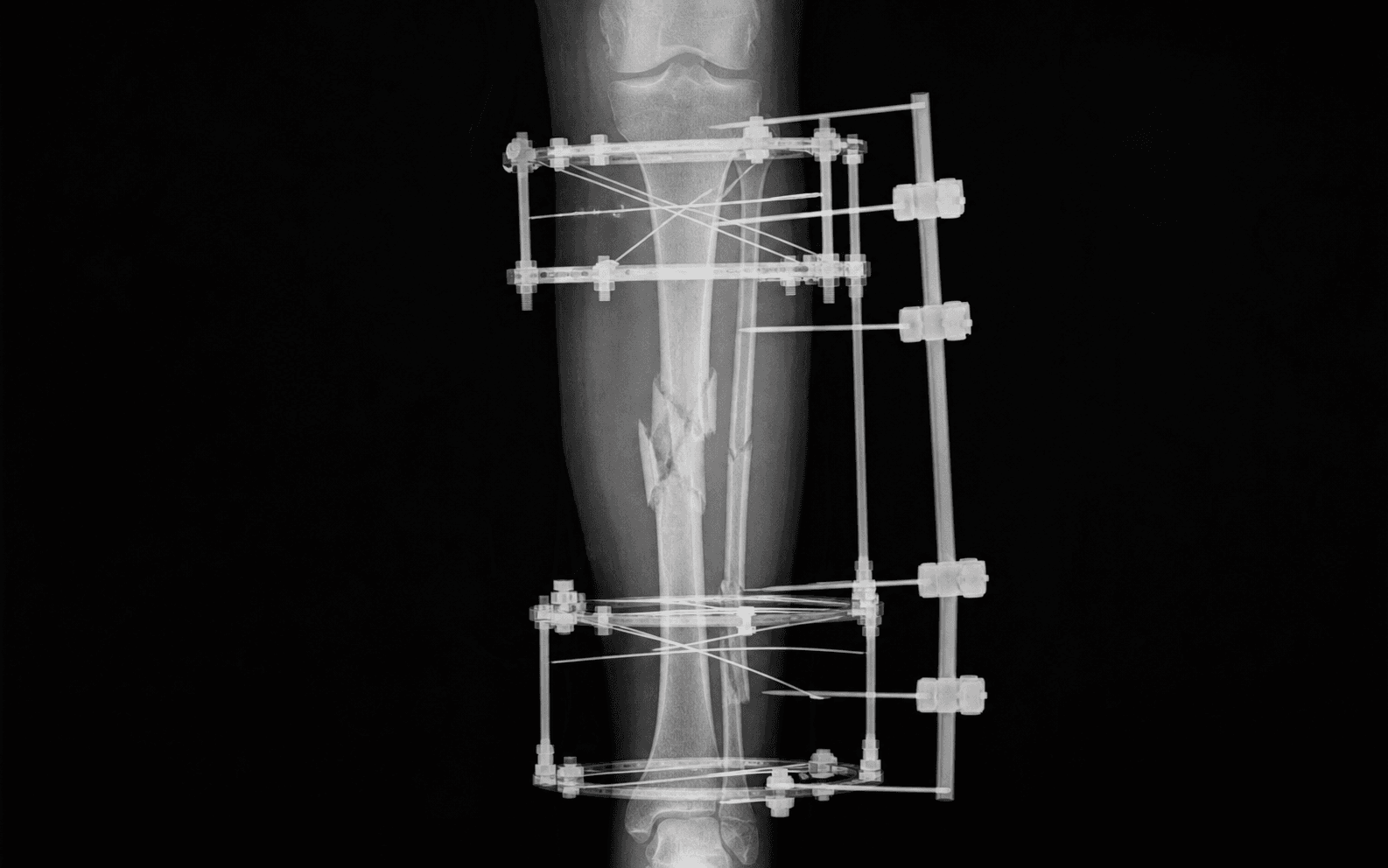 Ring external fixation
