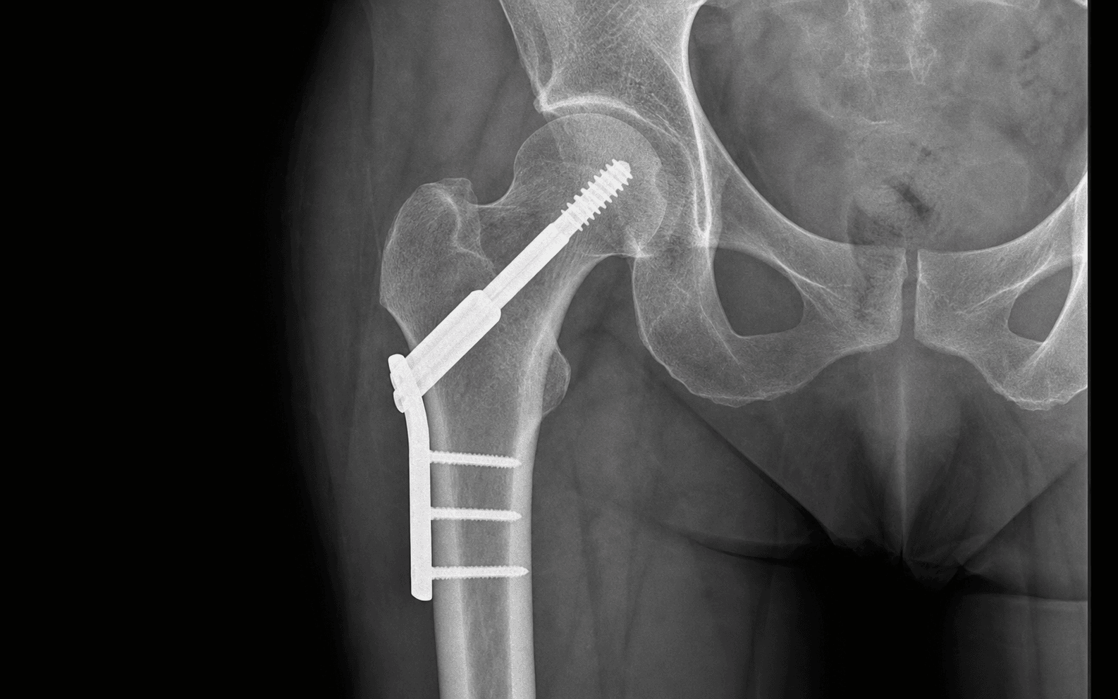Dynamic hip screw fixation
